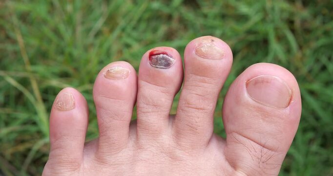Cinematic close-up of a bruised toenail with subungual hematoma trauma, blood under the middle toe nail injury concept