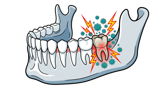 Jaw Bone Illustration with Severe Toothache and Bacterial Infection