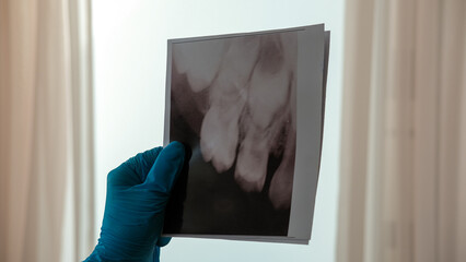 Black and white dental X-ray showing upper teeth and roots. Concept of dentistry, oral health, medical diagnostics, and dental care © leroy
