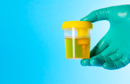 A doctor's hand in a medical glove holds a container of urine against a blue background. Conceptual illustration of a urine PCR test for sexually transmitted infections, chlamydia, and trichomonas