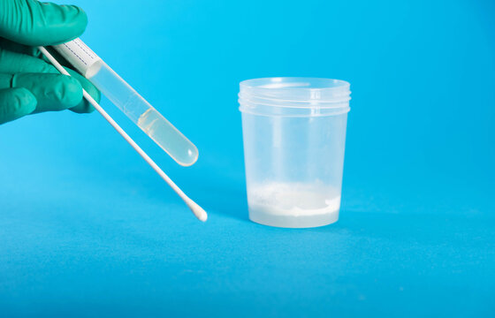 A laboratory technician's hand holds a medical swab against a background of ejaculate containing prostate fluid. Conceptual illustration of tests for sexually transmitted infections, chlamydia, and