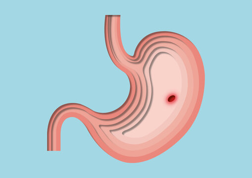 Stomach ulcer, conceptual illustration