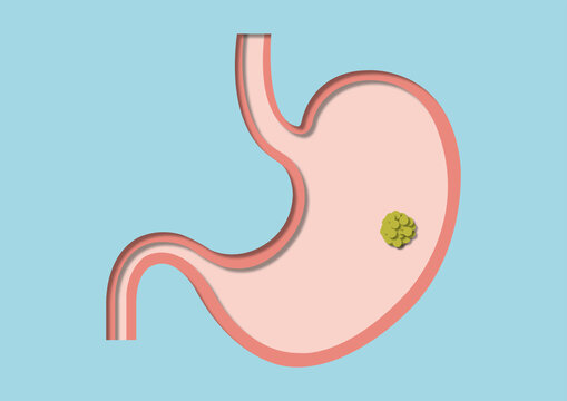 Stomach ulcer, conceptual illustration