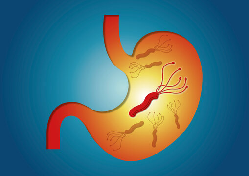 Bacterial stomach infection, conceptual illustration