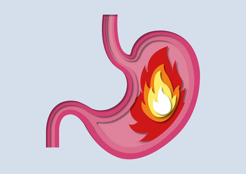 Gastritis, conceptual illustration