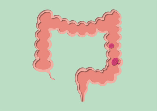Colon polyps, conceptual illustration