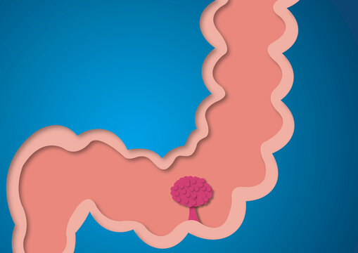 Colon polyp, conceptual illustration