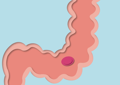 Colon polyp, conceptual illustration