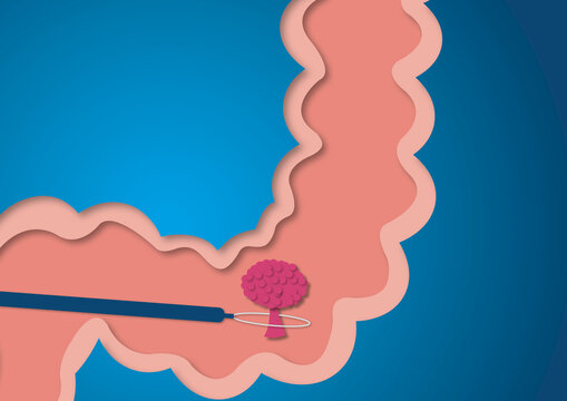 Colon polyp removal, conceptual illustration