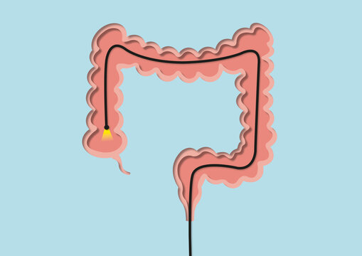 Colonoscopy, conceptual illustration
