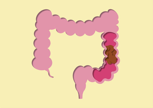 Constipation, conceptual illustration