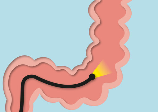 Colonoscopy, conceptual illustration