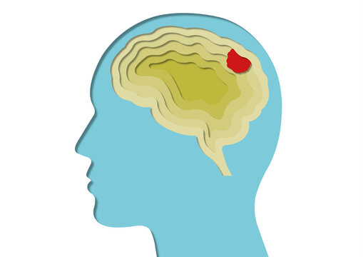 Brain tumour, conceptual illustration
