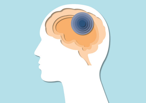 Brain ischaemia, conceptual illustration