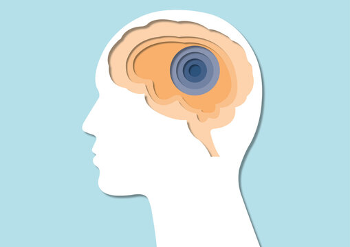 Brain ischaemia, conceptual illustration