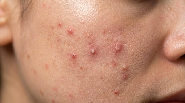 Close up acne skin texture on cheek