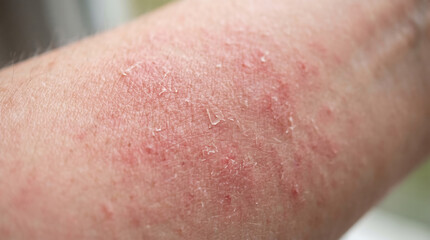 Fototapeta premium Allergic skin rash close up with red bumps and itchy eczema texture on adult arm for dermatological medical treatment and sensitive skin care ad.