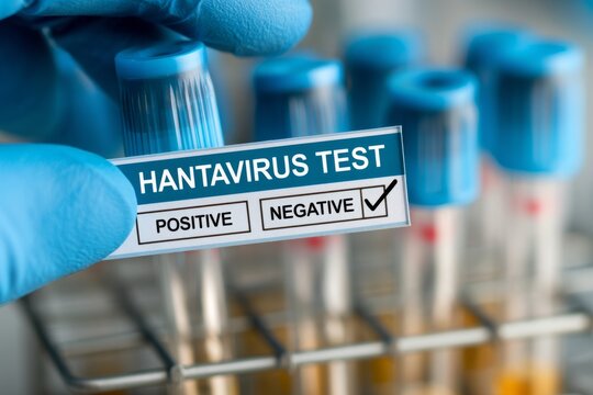 Close-up of hantavirus test label showing negative result on specimen tube in laboratory
