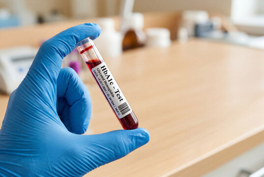 Doctor holding a blood sample tube for an hba1c test to monitor diabetes and blood sugar