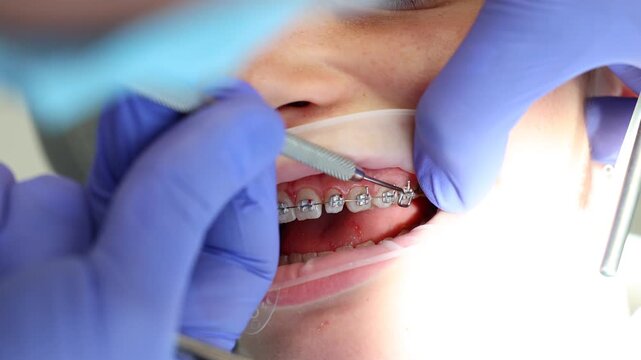 Orthodontist placing ligature ties on dental braces