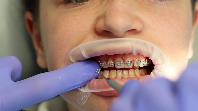 Orthodontist placing ligature ties on dental braces