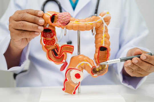 Colorectal cancer, doctor holding intestine colon human anatomy model.