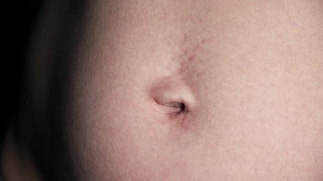 Navel close-up front view. A woman's stomach after pregnancy with stretch marks on the skin. A scar after laparoscopic surgery through the navel. Body part. Postoperative lymphatic edema on a abdomen.