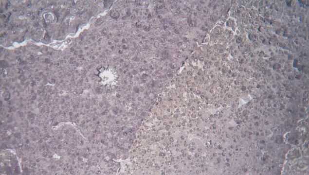 Bone Marrow Tissue Slide Showing Plasma Cell Malignancy Microscopic View, Cellular Detail