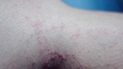 Fototapeta premium Close up itchy rash, red bumps, irritated skin representing cholinergic urticaria, allergic reaction, skin inflammation, dermatology problem, immunity response, healthcare condition.