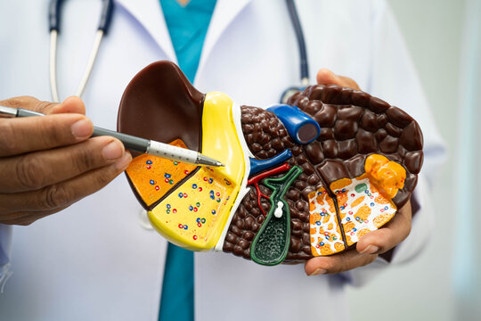 Cirrhosis, Liver cancer, fatty liver, Asian doctor with liver human anatomy model in World Hepatitis Day at hospital.