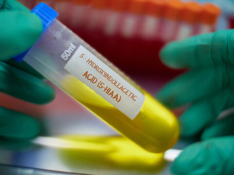 A scientist holds a test tube containing human urine to analyse 5-hydroxyindoleacetic acid (5-HIAA) in a laboratory