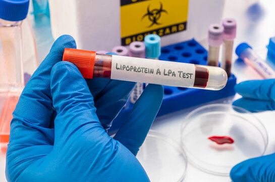 A scientist holds a vial containing a blood sample to analyse for lipoprotein a (LPa)
