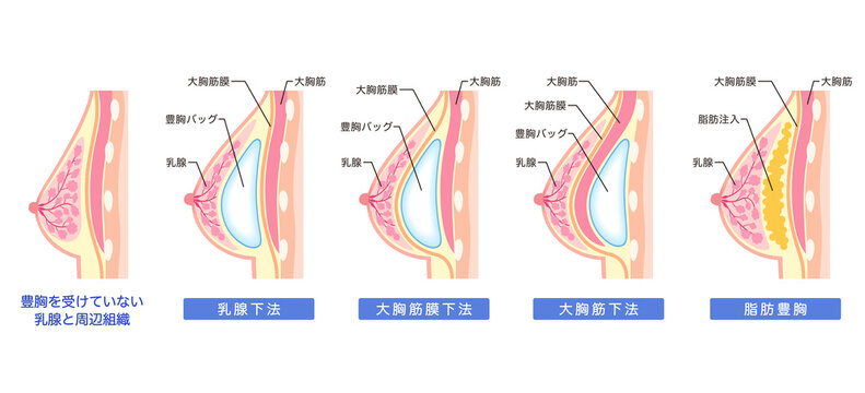 豊胸手術の種類　構造　豊胸