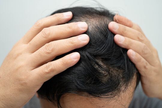 Bald in the middle head and begin no loss hair glabrous of mature man.