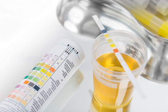 Routine test, urine rapid test, urine test strip, urine sample