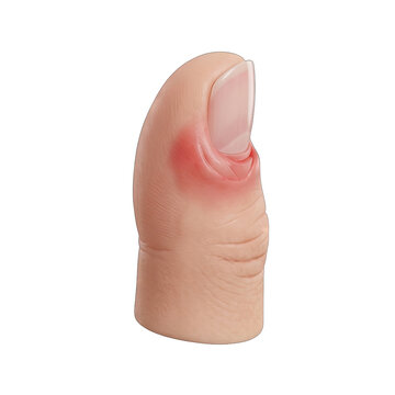 Close-up of Thumb with Paronychia Infection