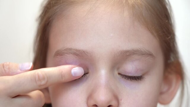 Mothers hand applies ointment to puffy child eye with barley. Insect bite allergy. Swelling eyelid. Conjunctivitis. Allergy. Medicine and health care