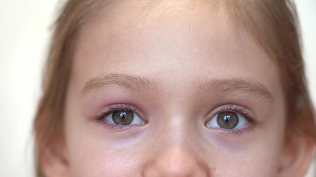 Close up of puffy child eye with barley. Insect bite allergy. Swelling eyelid. Conjunctivitis. Allergy. Medicine and health care