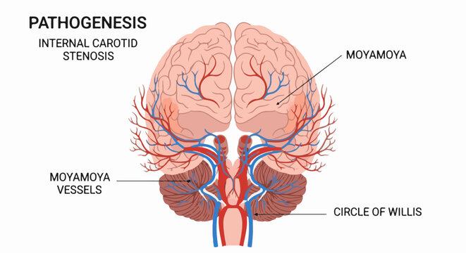 Anatomical illustration of the brain's vascular system detailing Moyamoya disease