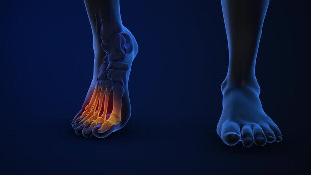 Human forefoot pain affecting metatarsal bone