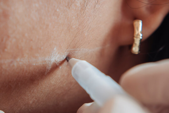 Female patient receiving jawline mapping at an aesthetic clinic before mesotherapy treatment for facial contour enhancement