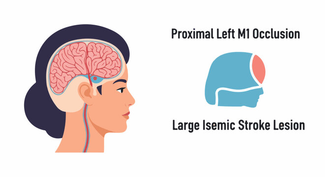 Illustration of a brain with proximal left M1 occlusion and lesion
