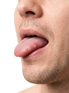 A close-up shot of a person's tongue with a visible canker sore. The image highlights the texture and appearance of the affected area