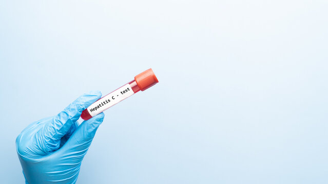 Blood sample tube with hepatitis C test label on medical laboratory technologist hands over blue background.