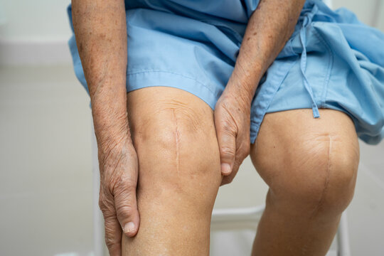 Asian elderly woman patient with scar knee replacement surgery in hospital.