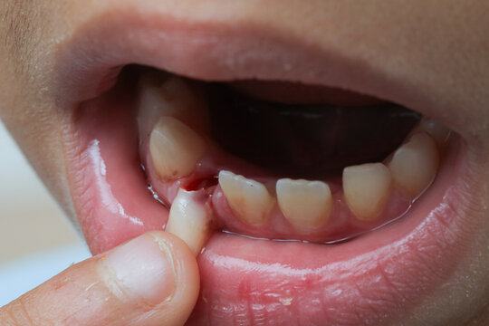 Child loosing baby tooth with blood on gum