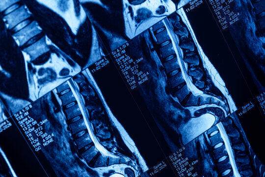 Mri scan of spine disc protrusion in vertebral column, pinched sciatic nerve in leg buttock