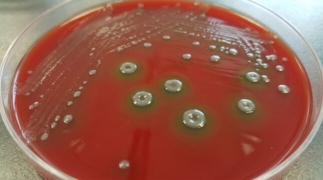 Pneumonia Streptococcal Culture Blood Agar Alpha Hemolysis. Streptococcus pneumoniae colonies with draughtsman morphology and alpha hemolysis on blood agar plate culture.