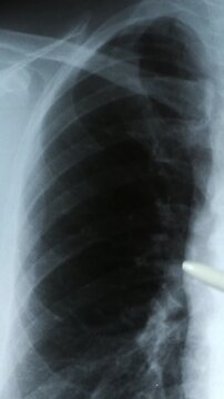 Doctor radiologically analyzing the chest with x-ray
Hand of a doctor analyzing and pointing with a pen to the affected area