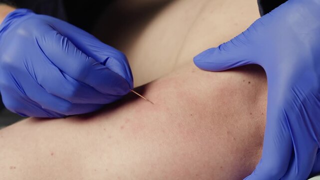 Chinese acupuncture needles, Adult male physiotherapist is doing acupuncture on the body back of a male patient. Patient is lying down on a bed, chinese sport medicine.
